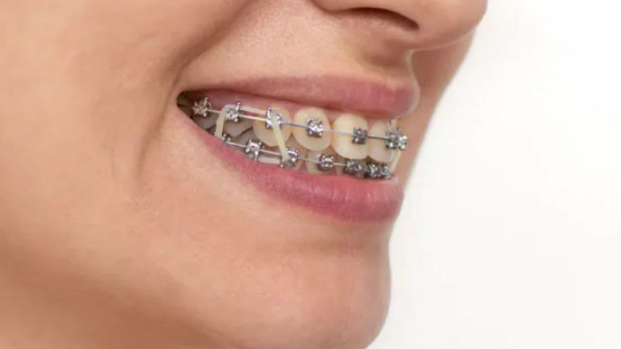 Why Should You Use Rubber Bands With Braces?